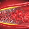 Stent ngoại biên