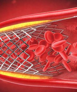Stent ngoại biên