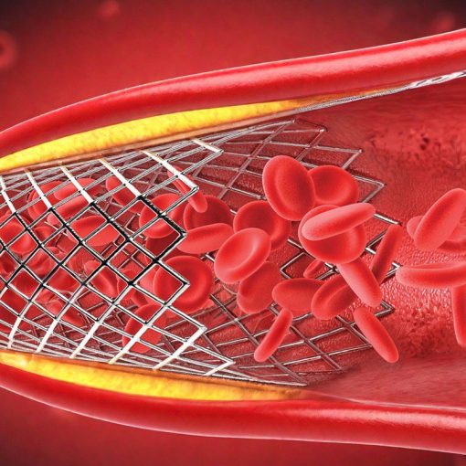 Stent ngoại biên