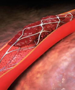 Stent thần kinh