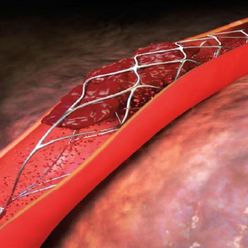 Stent thần kinh