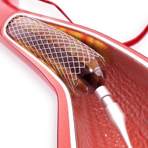 Stent tim mạch